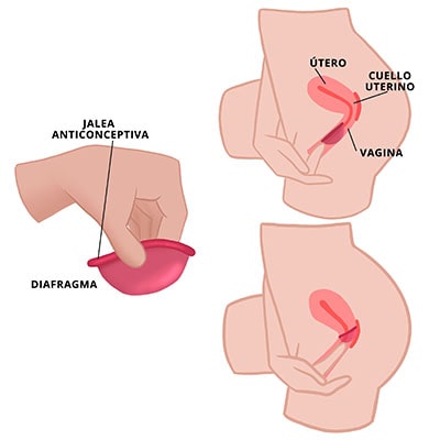 Cómo se coloca el diafragma