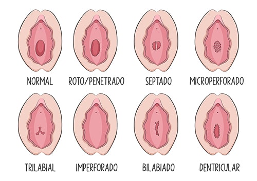 Tipos de himen