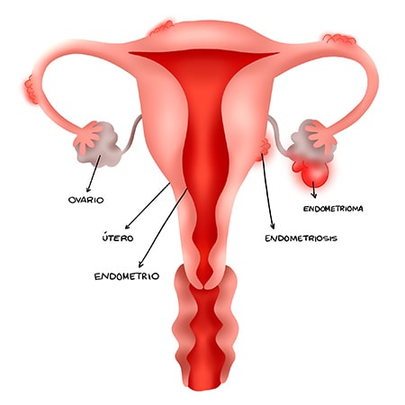 Endometriosis, qué es