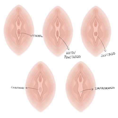 Los diferentes tipos de himen