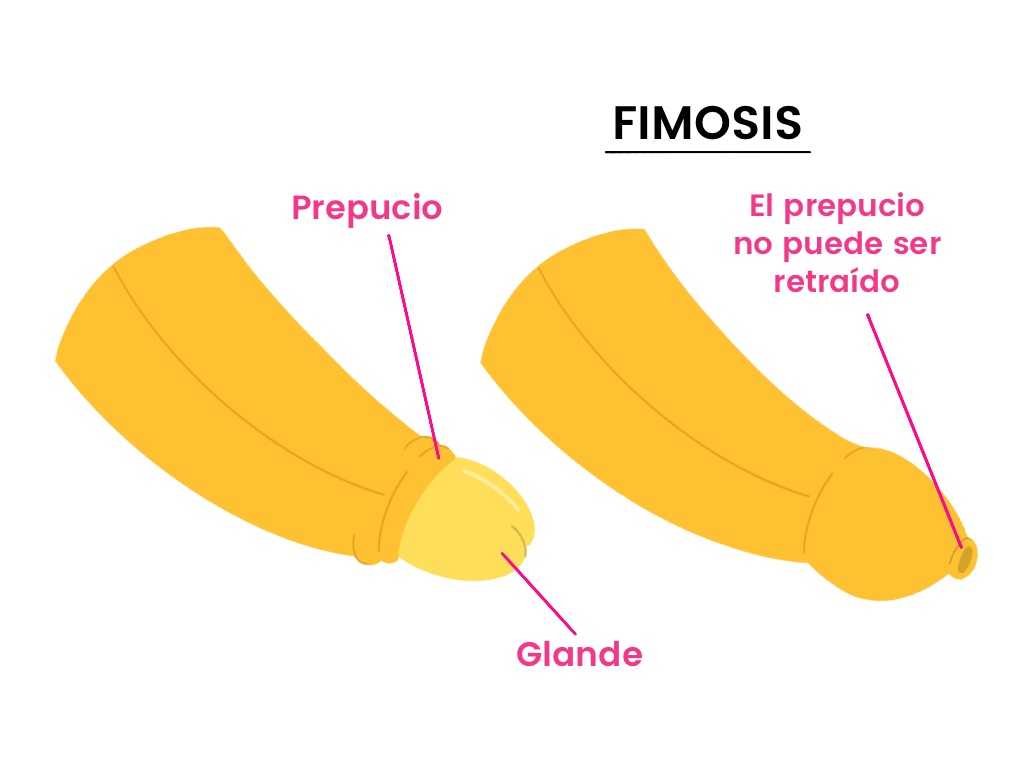 Qué es la fimosis Qué es la fimosis