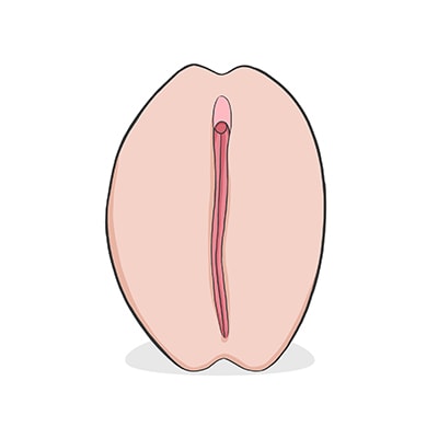 Vulva tipo barbie