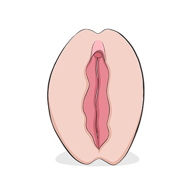 Vulva tipo buñuelo