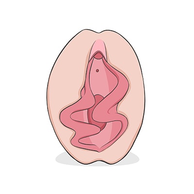 Vulva tipo flamenca