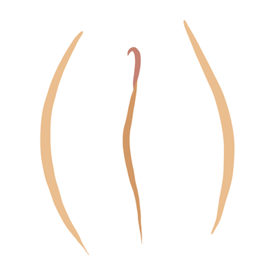 Vulva tipo buñuelo Vulva tipo buñuelo